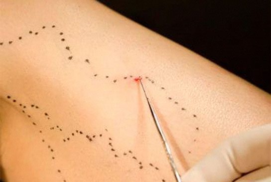 S - Microcirurgia Estética (Flebectomias) – Tratamento Eficaz para Remoção de Varizes 1 Microcirurgia Estética (Flebectomias) – Tratamento Eficaz para Remoção de Varizes