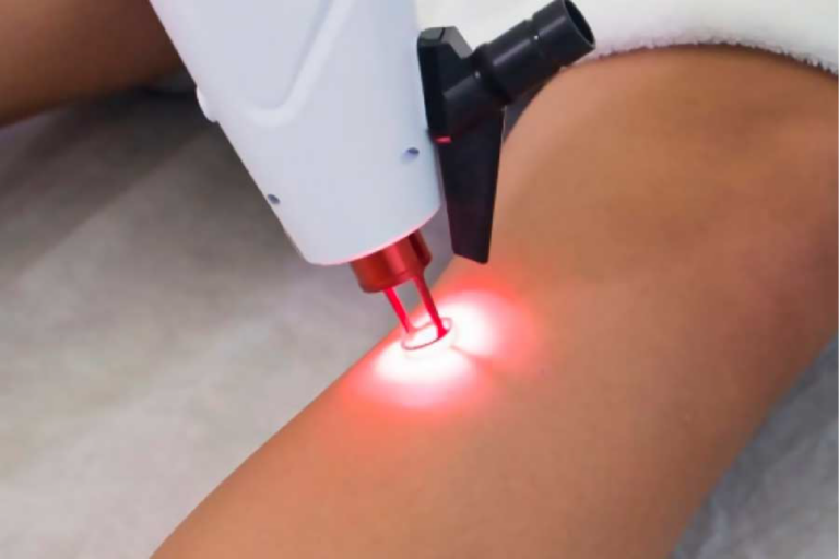 S - Laser Transdérmico para Varizes Superficiais | Dr. Victor Livera Recife 2 laser transdérmico em recife