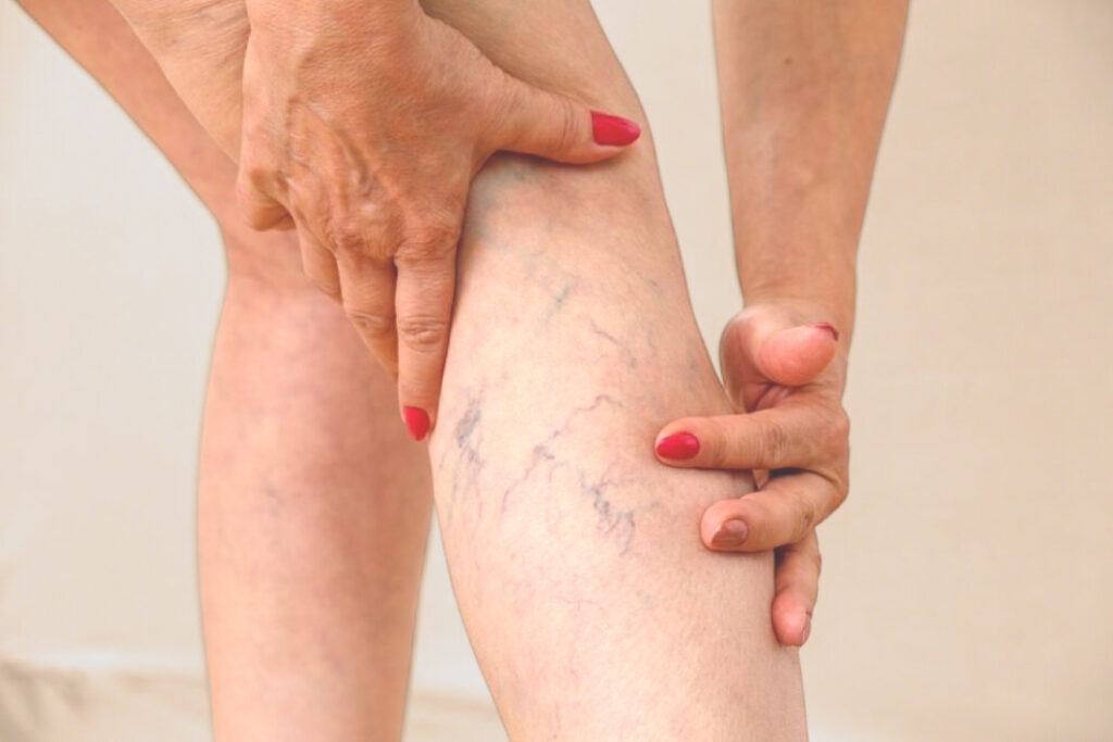 endolaser em recife dr victor livera