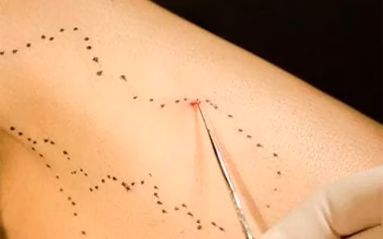 Microcirurgia de varizes: veias marcadas na pele e instrumento retirando a veia
