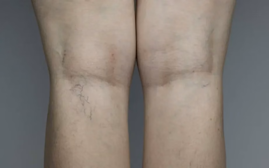Vasinhos e veias dilatadas atrás dos joelhos